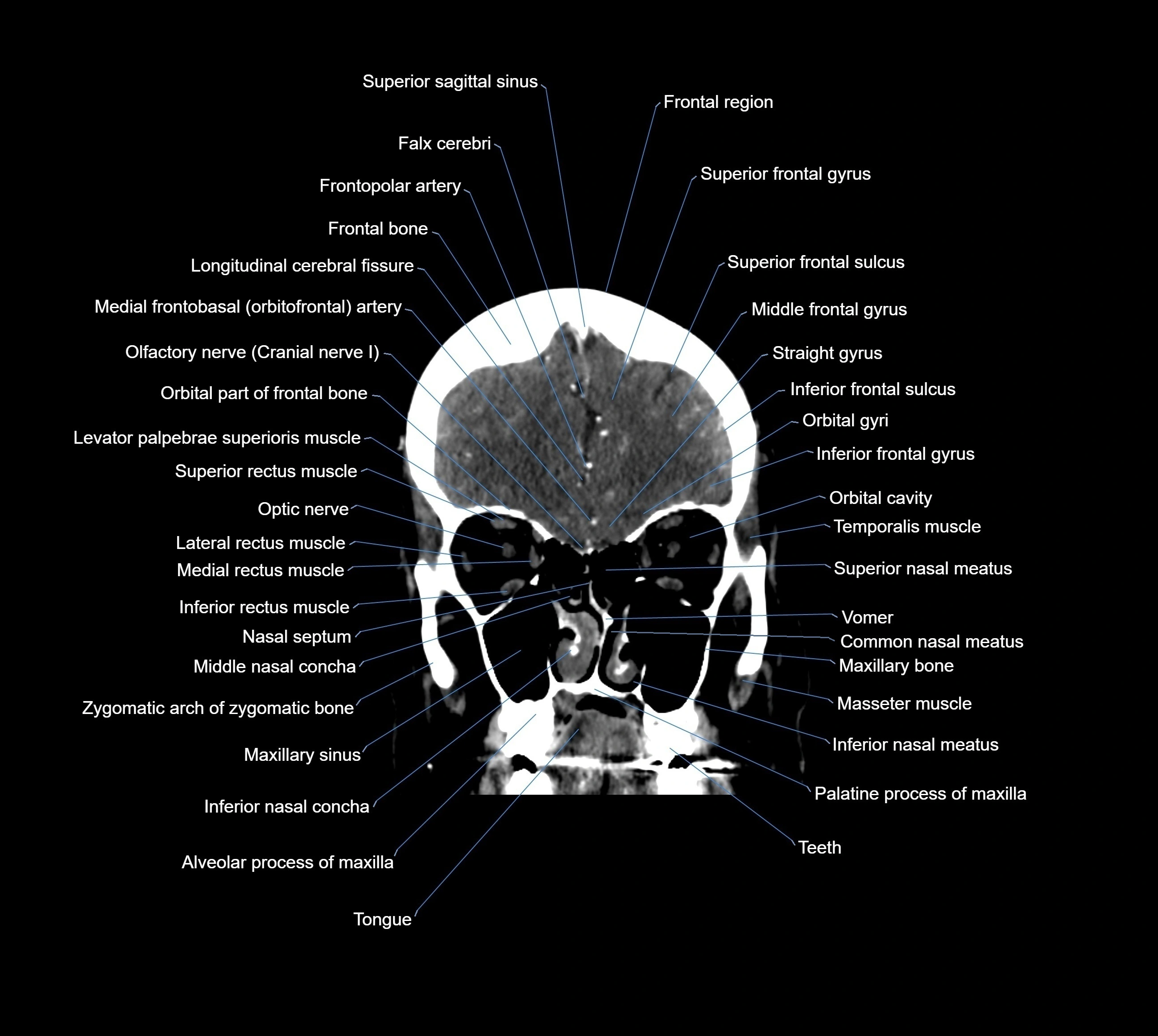 CT Brain coronal cross sectional radiology anatomy image  -img-00001-012.webp
